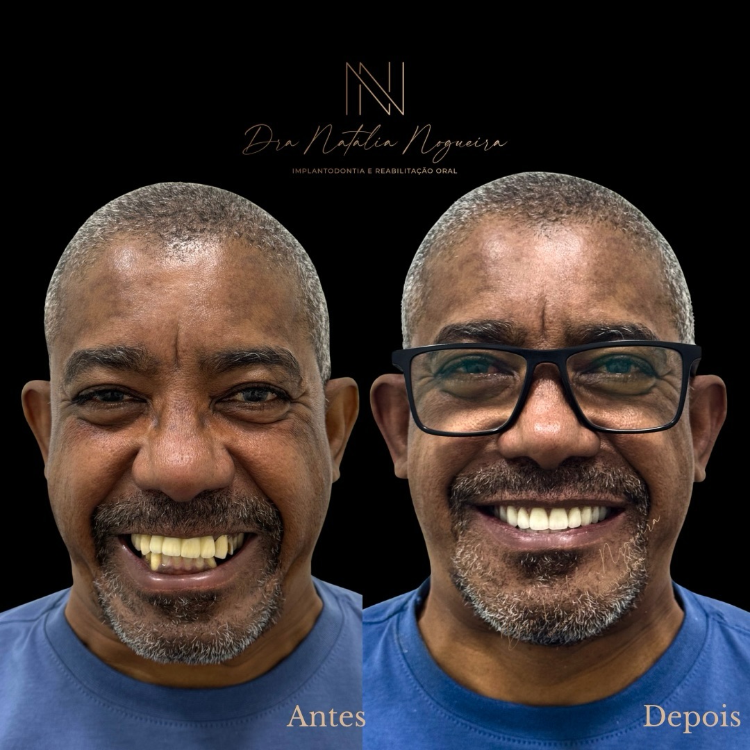 Sorriso Renovado (antes e depois)